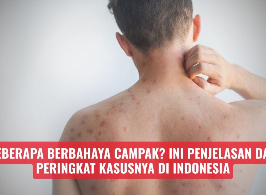 Seberapa Berbahaya Campak? Ini Penjelasan dan Peringkat Kasusnya di Indonesia