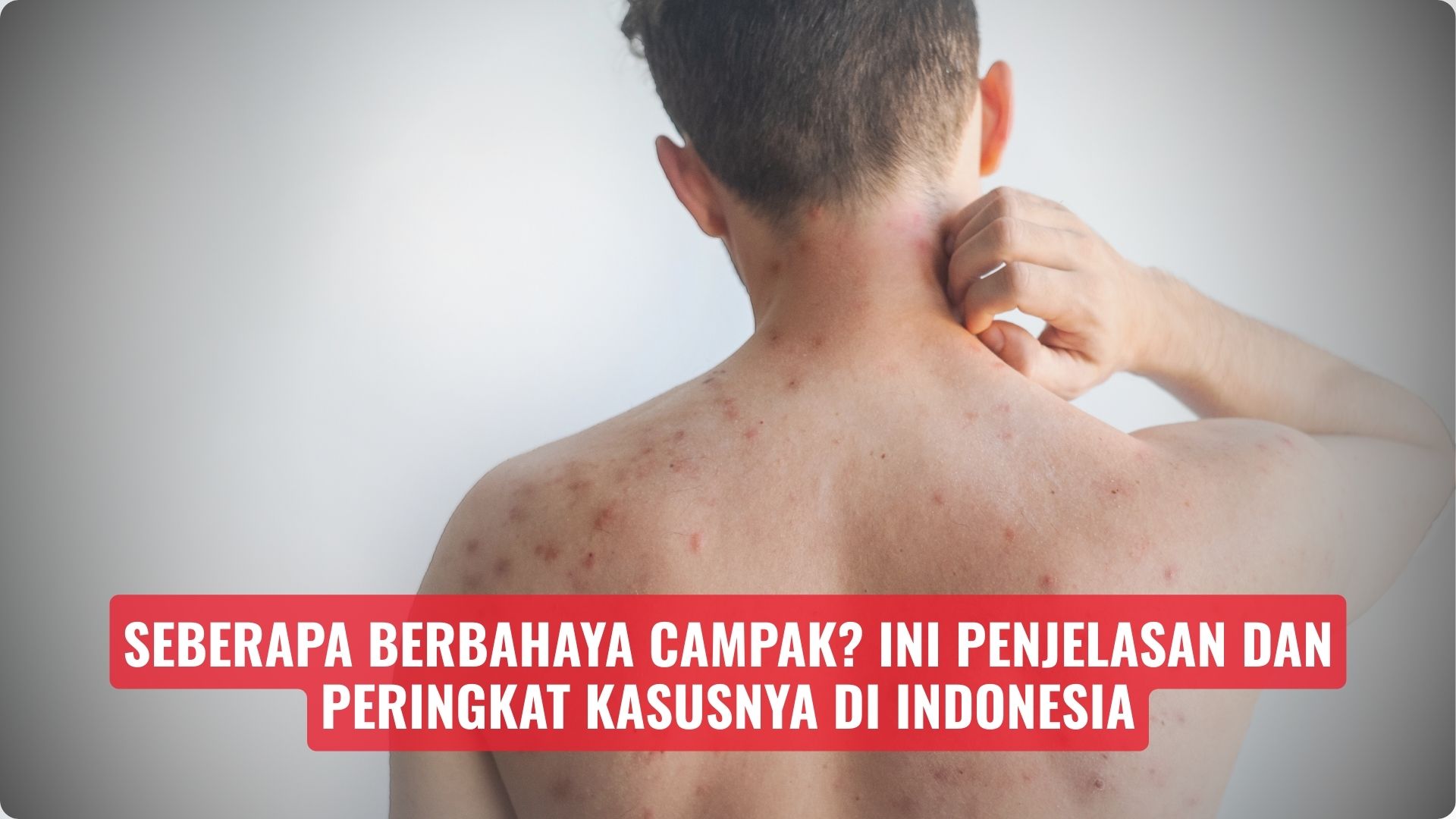Seberapa Berbahaya Campak? Ini Penjelasan dan Peringkat Kasusnya di Indonesia